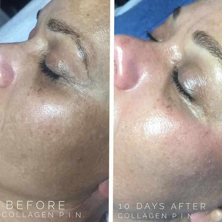 Collagen P.I.N.