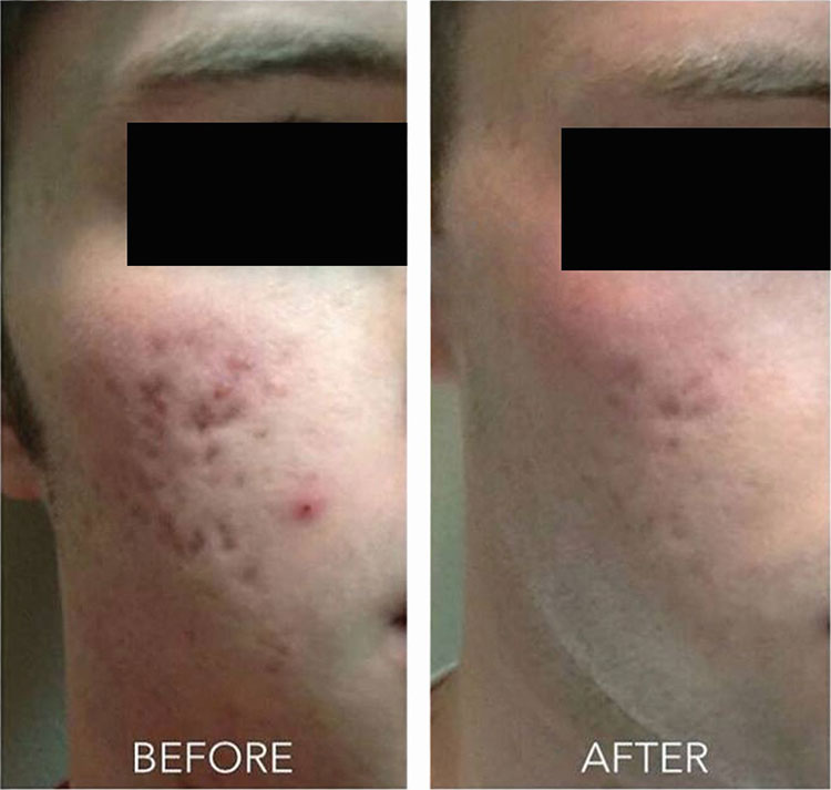 Collagen P.I.N. Micro-Needling