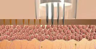 Microneedline illustration