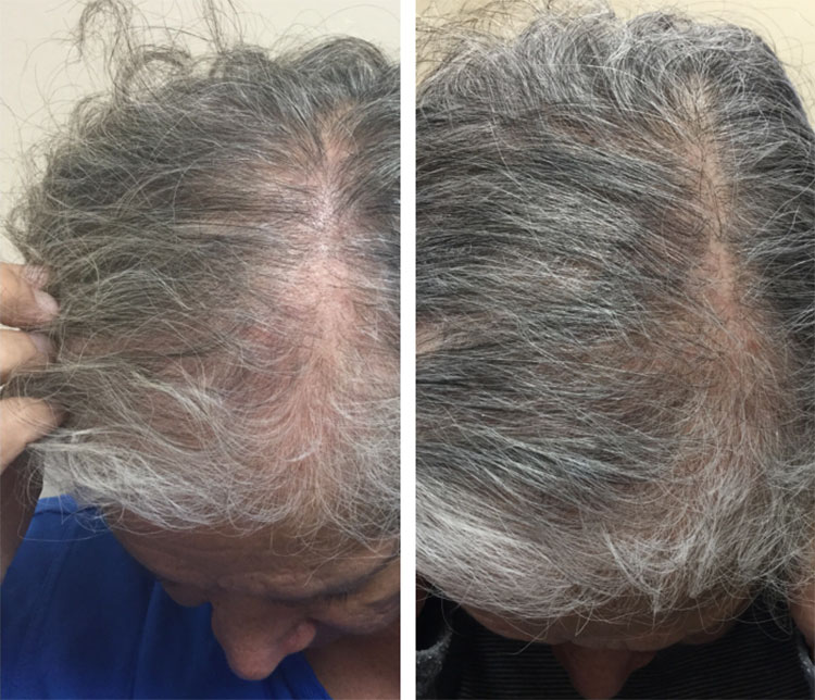Hair Restoration