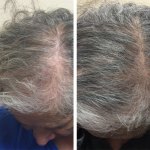 Hair Restoration