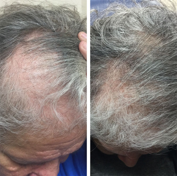 Hair Restoration