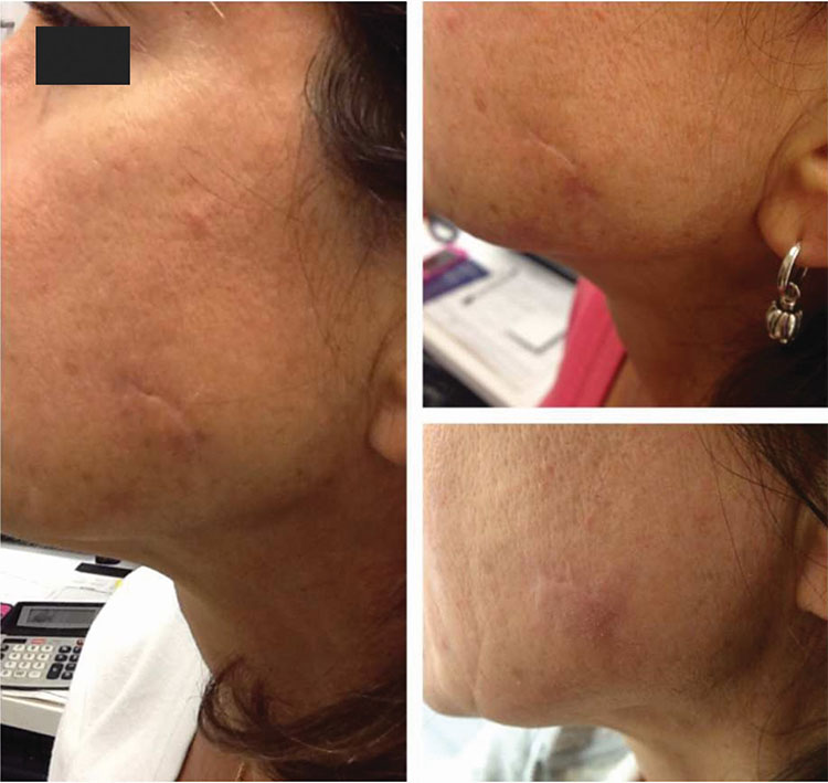 Collagen P.I.N. Micro-Needling