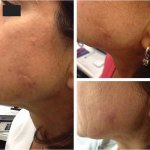 Collagen P.I.N. Micro-Needling