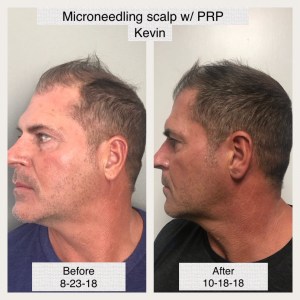 Male Pattern Baldness Case Study