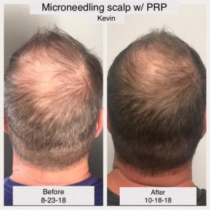 Male Pattern Baldness Case Study