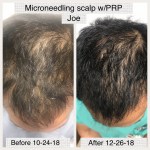 microneedling case study