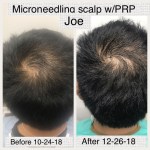 microneedling case study
