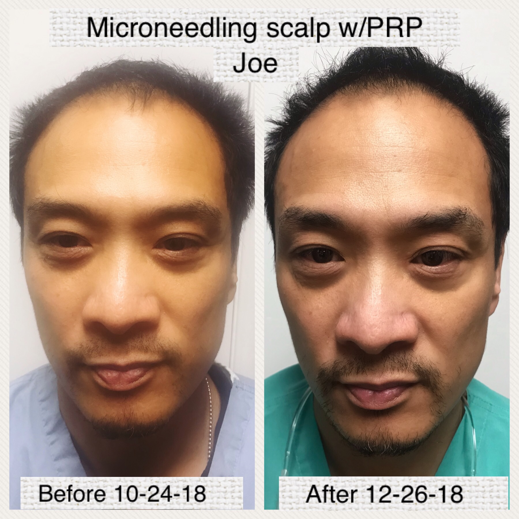 microneedling case study