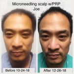 microneedling case study