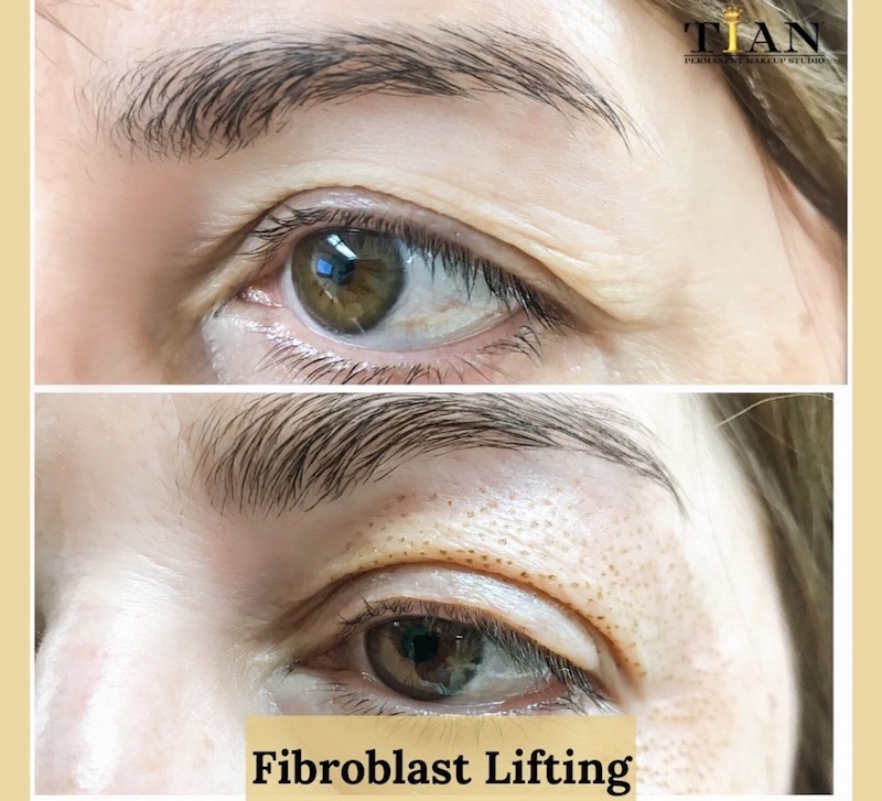 Before/After