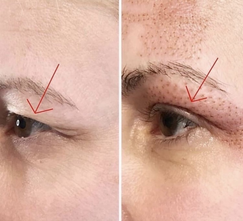 Before/After